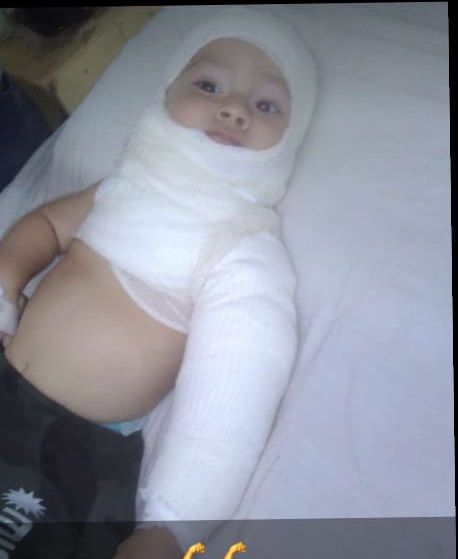 Colonia Victoria: Un bebe de un año sufrió quemaduras de gravedad y necesita colaboración
